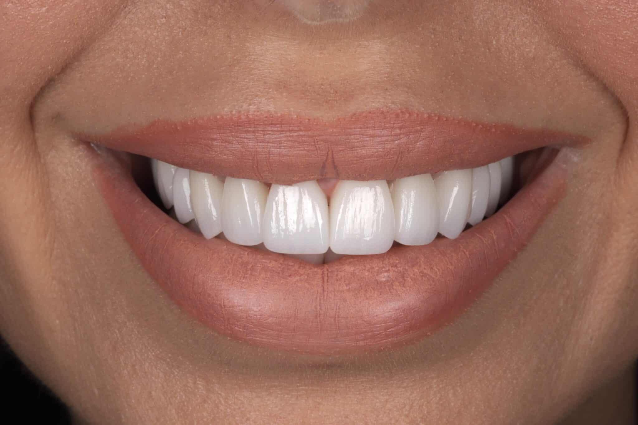 Porcelain Veneers Leeds Veneers Leeds Dr. Phil